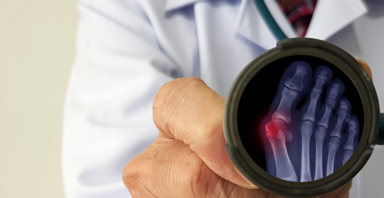 chirurgie micro-invasive d’un hallux valgus